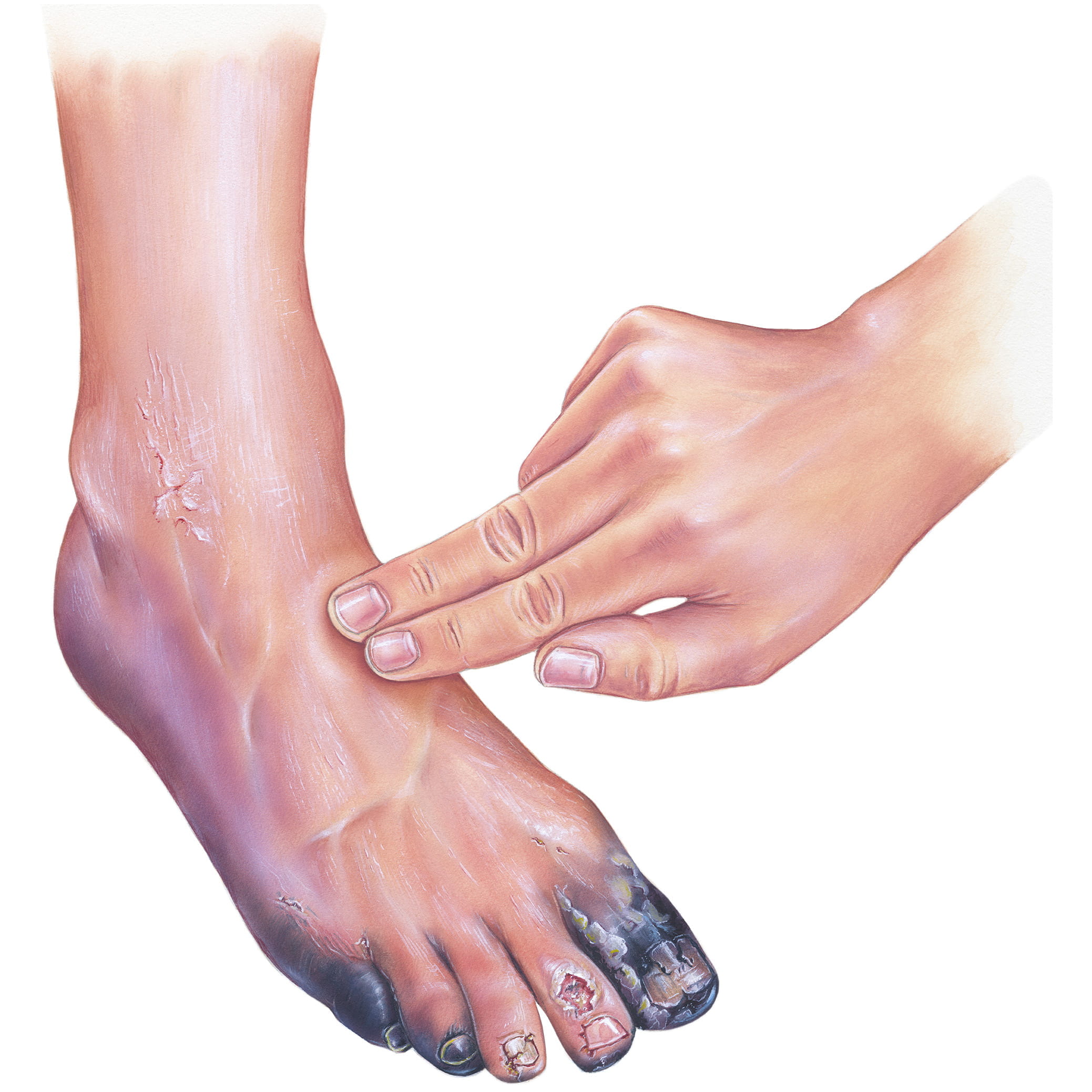Diabetfoot